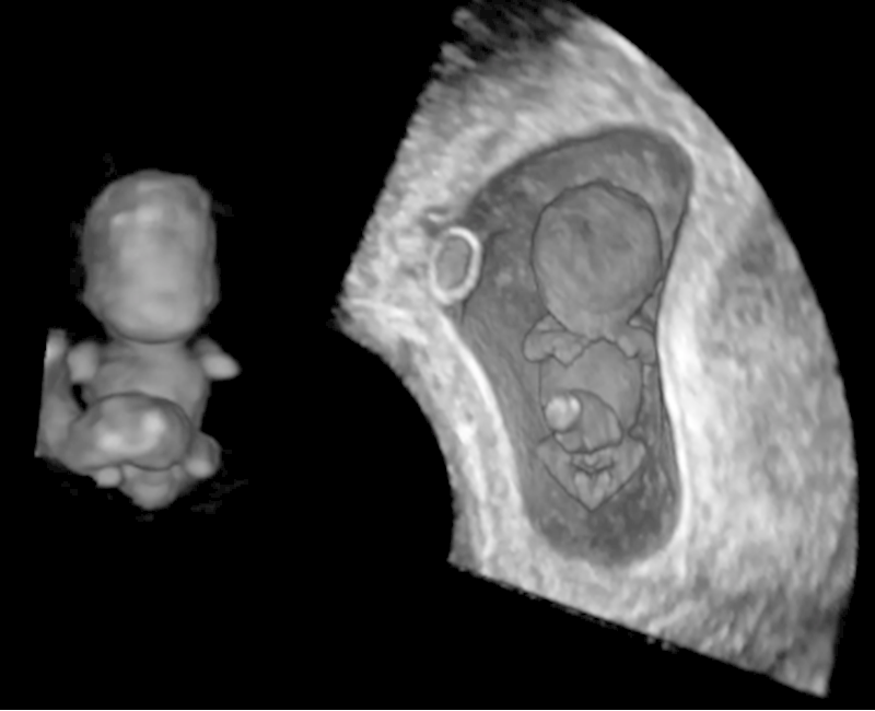 Study examines embryo development in pregnant women